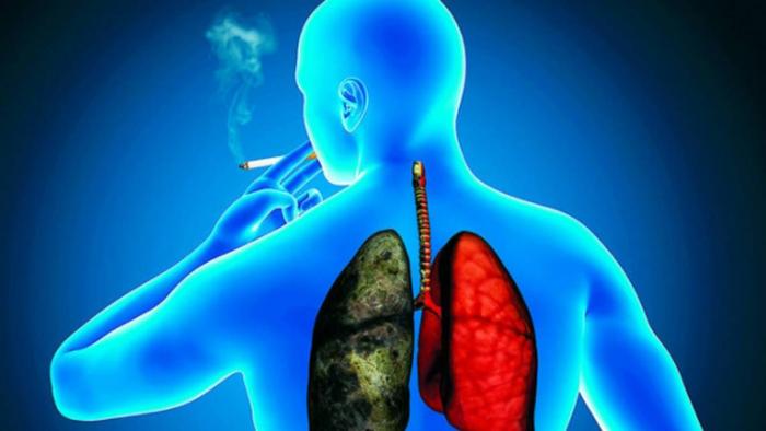 El cáncer de pulmón, que se ve en mayor número en los fumadores, es el responsable del fallecimiento anual de más de 1,8 millones de personas en el mundo.