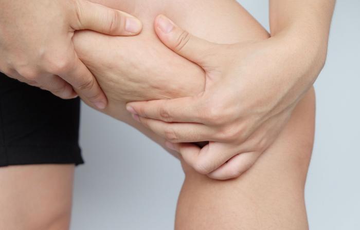 Celulitis
