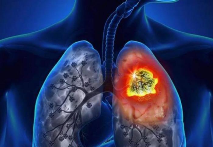En la gráfica puede observarse lesiones pulmonares