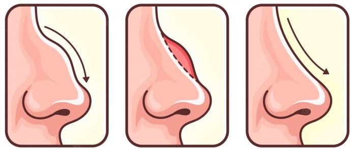infografia-rinoplastia-dibujada-mano_23-2149346371