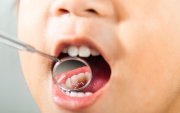 La caries dental continúa siendo una de las enfermedades más frecuentes en Ecuador, afectando especialmente a niños y escolares.