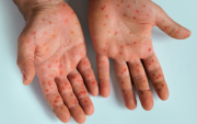 Erupciones o lesiones cutáneas aparecen en la cara, las palmas de las manos y las plantas de los pies en casos de viruela símica o mpox.