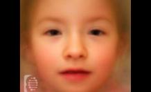 sindrome-TRAF7-enfermedad-rara-cara-foto