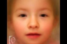 sindrome-TRAF7-enfermedad-rara-cara-foto