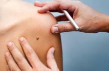 melanoma