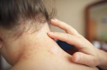 Mujer con psoriasis