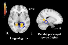 La activación cerebral en el giro lingual y en el giro parahipocampal, áreas involucradas en la percepción del dolor, disminuyó significativamente después de ver imágenes nostálgicas en comparación con las imágenes de control.