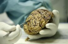 Un científico observa un cerebro humano enfermo de alzheimer, en una foto de archivo.