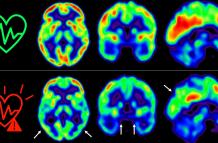 Las imágenes representan la captación de glucosa en el cerebro en individuos de mediana edad con bajo (arriba) o alto (abajo) riesgo cardiovascular sostenido 5 años.