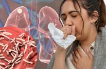 tuberculosis
