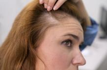 mujer-recibiendo-un-tratamiento-de-perdida-de-cabello-en-una-clinica
