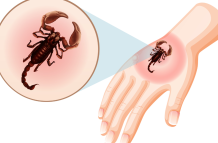 Imagen simbólica de picadura de alacrán.