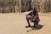 Paciente de micetoma