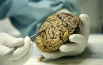 Un científico observa un cerebro humano enfermo de alzheimer, en una foto de archivo.