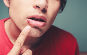 Besar a un niño con herpes labial activo puede poner en riesgo su salud ocular y general.
