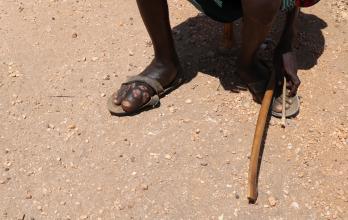 Paciente de micetoma