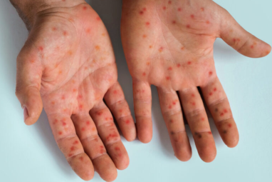 Erupciones o lesiones cutáneas aparecen en la cara, las palmas de las manos y las plantas de los pies.