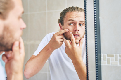 Las pieles secas o mixtas pueden desarrollar estas lesiones.