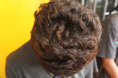 El hincha canario, "Jordan", muestra a EXPRESO las suturas que tiene en su cabeza tras sobrevivir al accidente mortal en Perú.