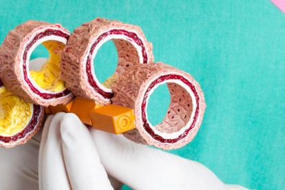 En la gráfica se simula cómo ocurre la acumulación de grasa en las arterias.