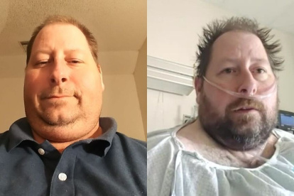 Brian Hitchens, antes y después de la infección.