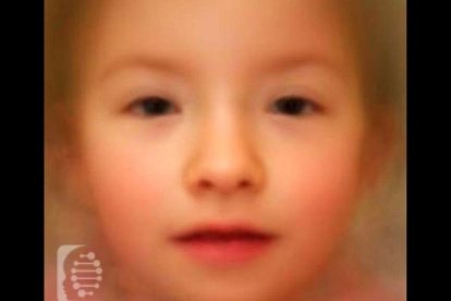 El síndrome TRAF7 genera rasgos faciales particulares. Este es un retrato robot del síndrome que puede ayudar a los pediatras a identificar a los pacientes afectados.