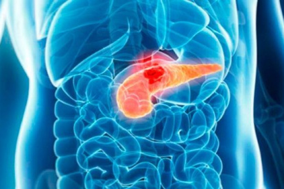 El hallazgo puede cambiar la manera en la que se trata el cancer de páncreas.