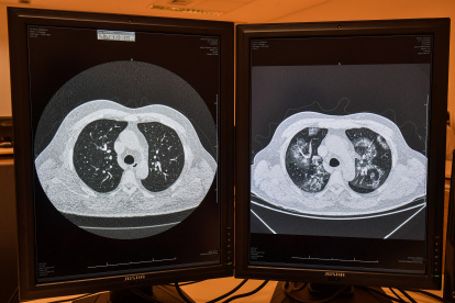 Imágenes de tomografías comparando un pulmón sano (izq) con uno afectado por coronavirus en el mismo paciente.