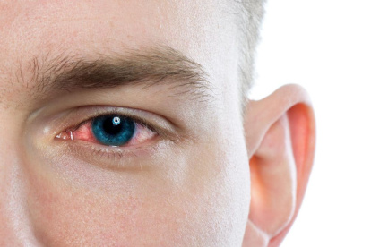 Identifican la conjuntivitis como síntoma principal de la Covid-19.