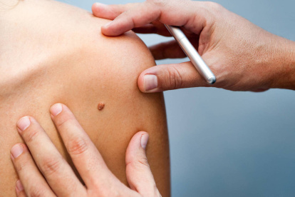 El sistema que analiza las fotografías puede clasificar y distinguir lesiones cutáneas sospechosas, potencialmente pre-cancerosas.