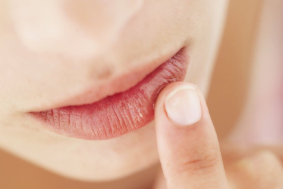 Herpes en la comisura de los labios