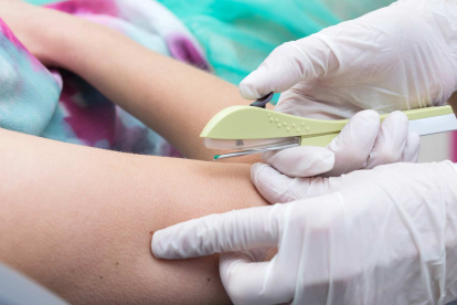 El implante debe colocarlo en médico con experiencia