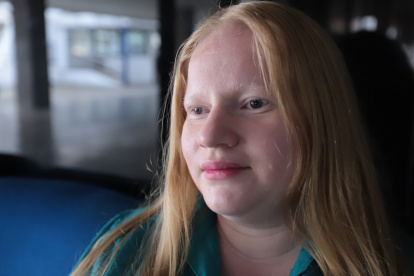 Nathaly Tite, albina de 31 años.