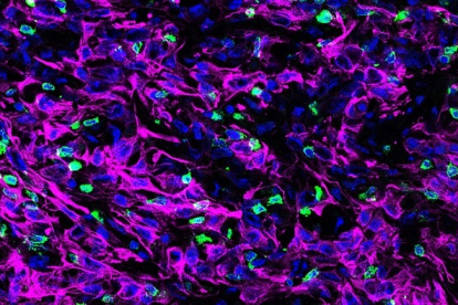 Un corte transversal de tejido tumoral pancreático de ratón