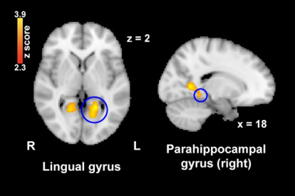 La activación cerebral en el giro lingual y en el giro parahipocampal, áreas involucradas en la percepción del dolor, disminuyó significativamente después de ver imágenes nostálgicas en comparación con las imágenes de control.