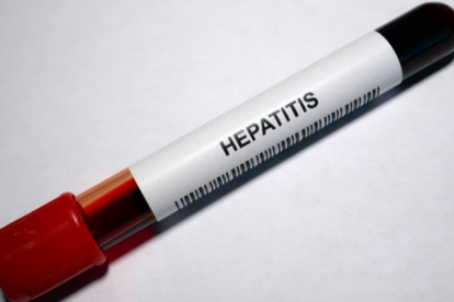 Referencial hepatitis.