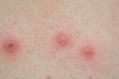 Viruela, referencial.