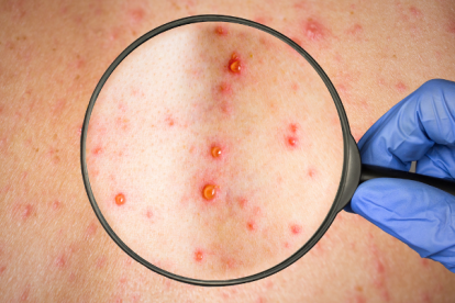 Las erupciones en la piel es uno de los síntomas de la viruela del mono.