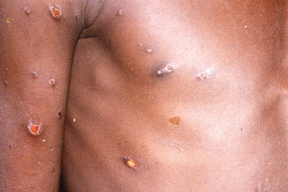 La viruela del mono produce lesiones cutáneas, fiebre y dolor corporal en las personas afectadas por el virus.