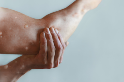 Referencial de viruela del mono.