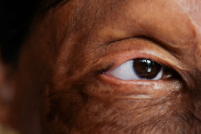 Secuelas de ataque con ácido