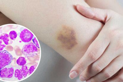 Se conoce como leucemia al cáncer de las células sanguíneas.