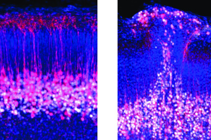 Neuronas piramidales de la capa cinco del córtex en ratones normales (izquierda) comparados con ratones con el gen del autismo eliminado (derecha), mostrando un parche de corteza desorganizada.
