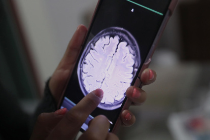 Un equipo de científicos de la Northwestern University ha conseguido que la quimioterapia más potente llegue al cerebro para tratar los gioblastomas.