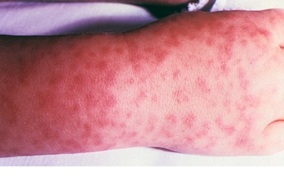 La enfermedad es endémica en América y se encuentra extendida desde América del Sur hasta Estados Unidos.