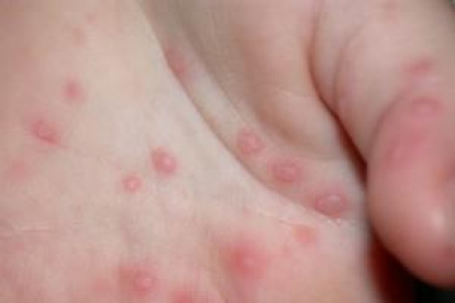 Imagen facilitada por la Asociación Española de Pediatría de un paciente afectado por  el síndrome de manos, pies y boca.