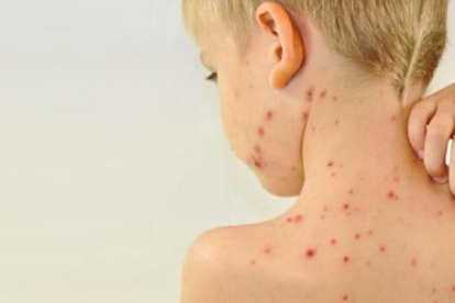 Imagen referencial de niño con sarampión.