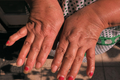Una mujer muestra su manos con artritis reumatoide en una imagen de archivo.