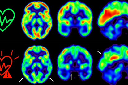 Las imágenes representan la captación de glucosa en el cerebro en individuos de mediana edad con bajo (arriba) o alto (abajo) riesgo cardiovascular sostenido 5 años.