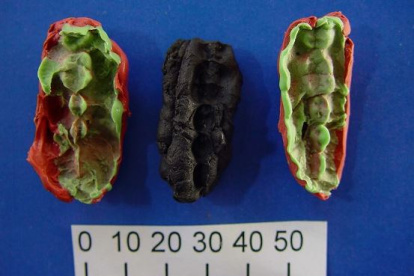 Las caries y las enfermedades de las encías ya acuciaban al hombre hace 10.000 años